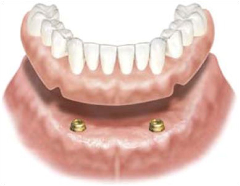 Immediate Dentures Procedure Kansas City MO 64127